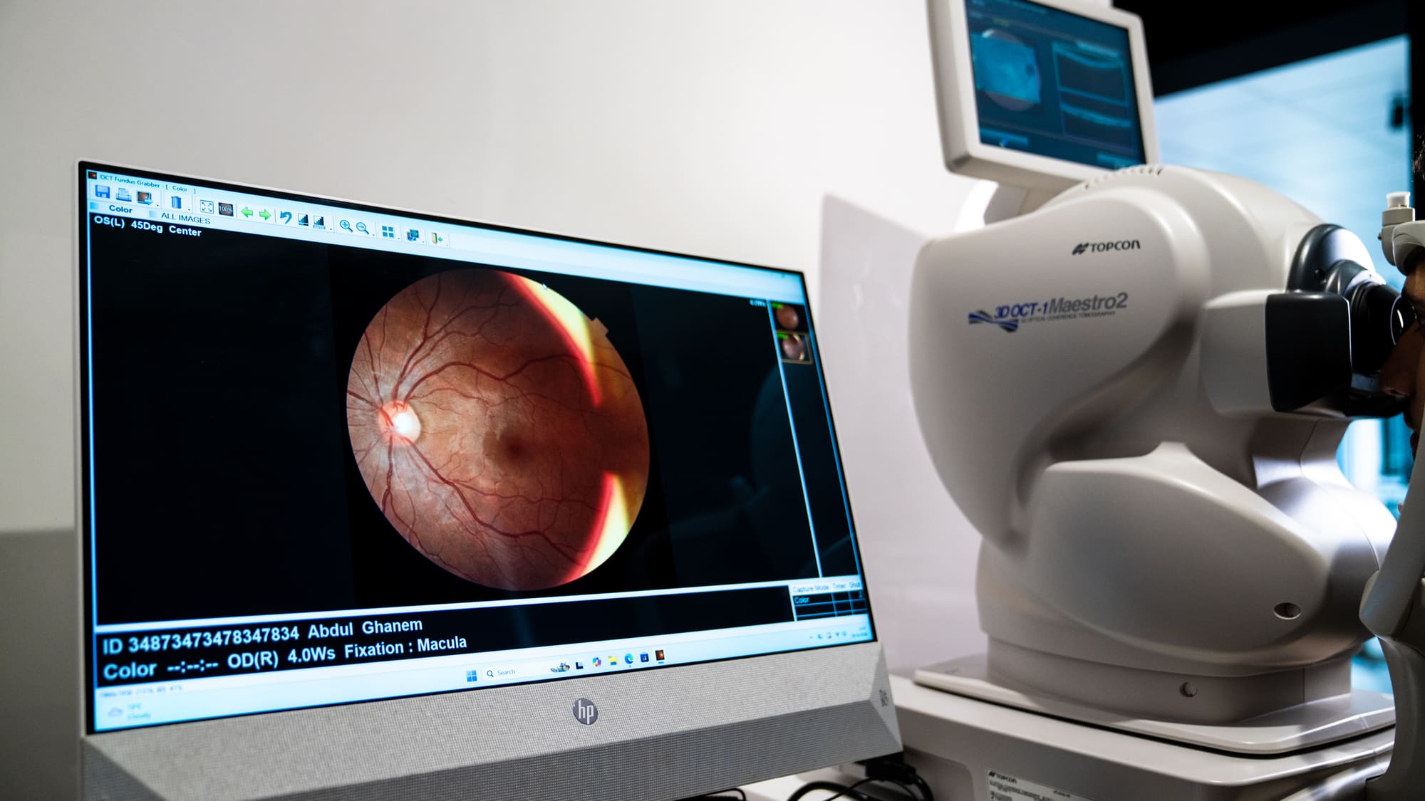 Retinal photograph on screen beside the OCT scanner