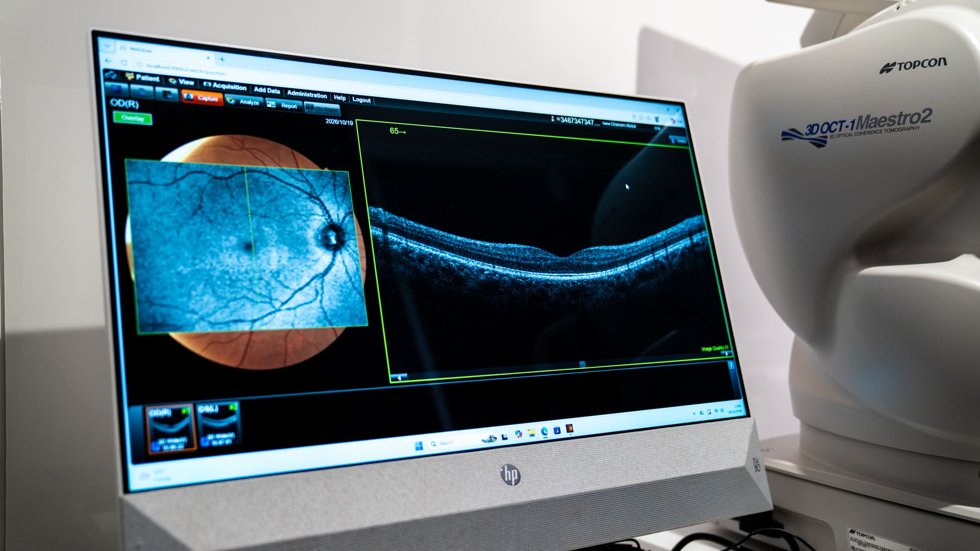 Retinal OCT scan results on screen